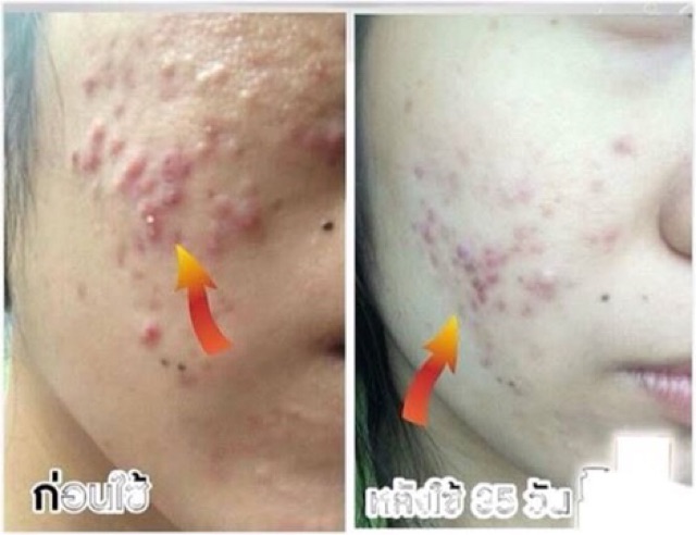 สบู่รักษาสิว หน้าใส ฝ้าจาง แทบไม่ต้องใช้ครีม รูปที่ 2