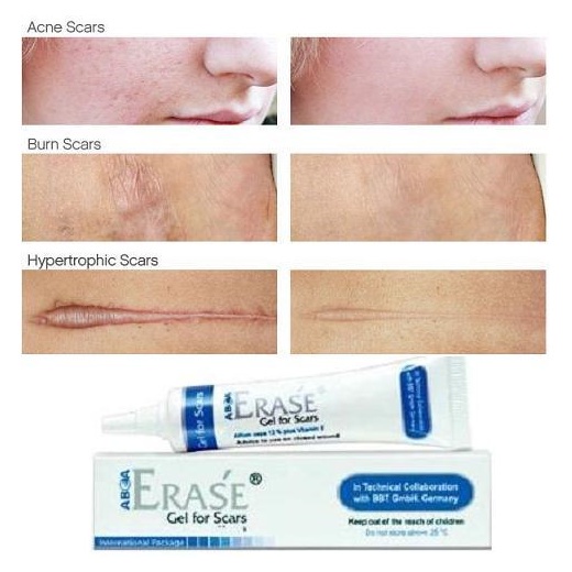 🔥1 หลอด แถมปากกา   หมดอายุ 2/2027 ของแท้100% ส่งไว🔥  Erase Gel  ลบแผลเป็น ดีมาก รพ.ชั้นนำเลือกจ่าย อ
