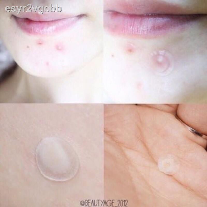 ✌(แท้ / พร้อมส่ง) OLIVE YOUNG แผ่นแปะสิว/ ดูดหัวสิว 102 ชิ้น