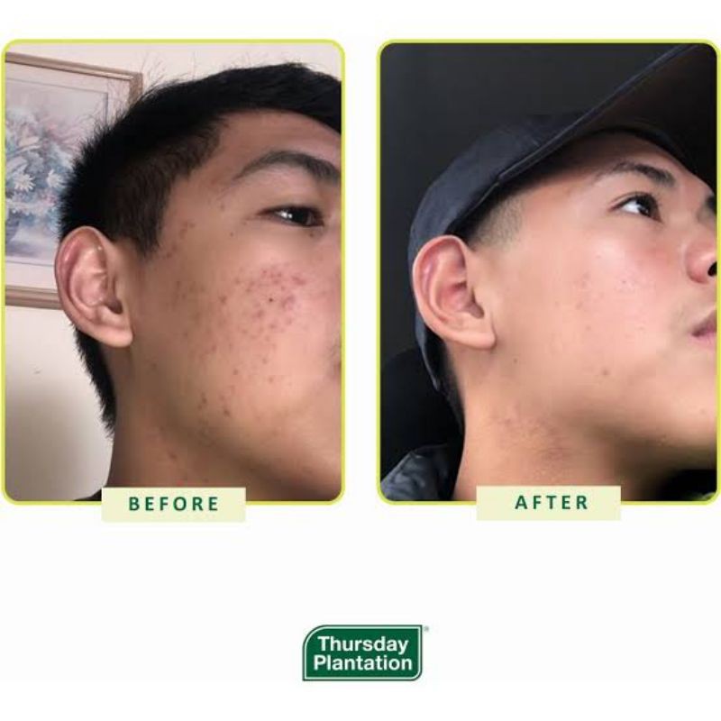 thursday plantation tea tree acne control kit