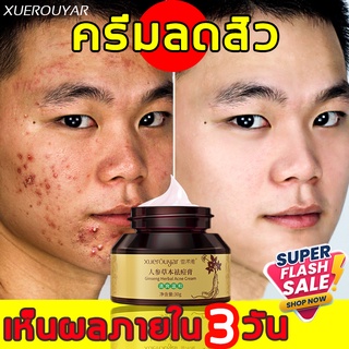 XUEROUYAR โสมสมุนไพร ครีมกำจัดสิว 30g เจลรักษาสิว ดูแลผิวหน้า ห่างไกลสิว (ครีมลดสิว,ครีมแต้มสิว,ครีมหน้าขาวใส,เจลแต้มสิว