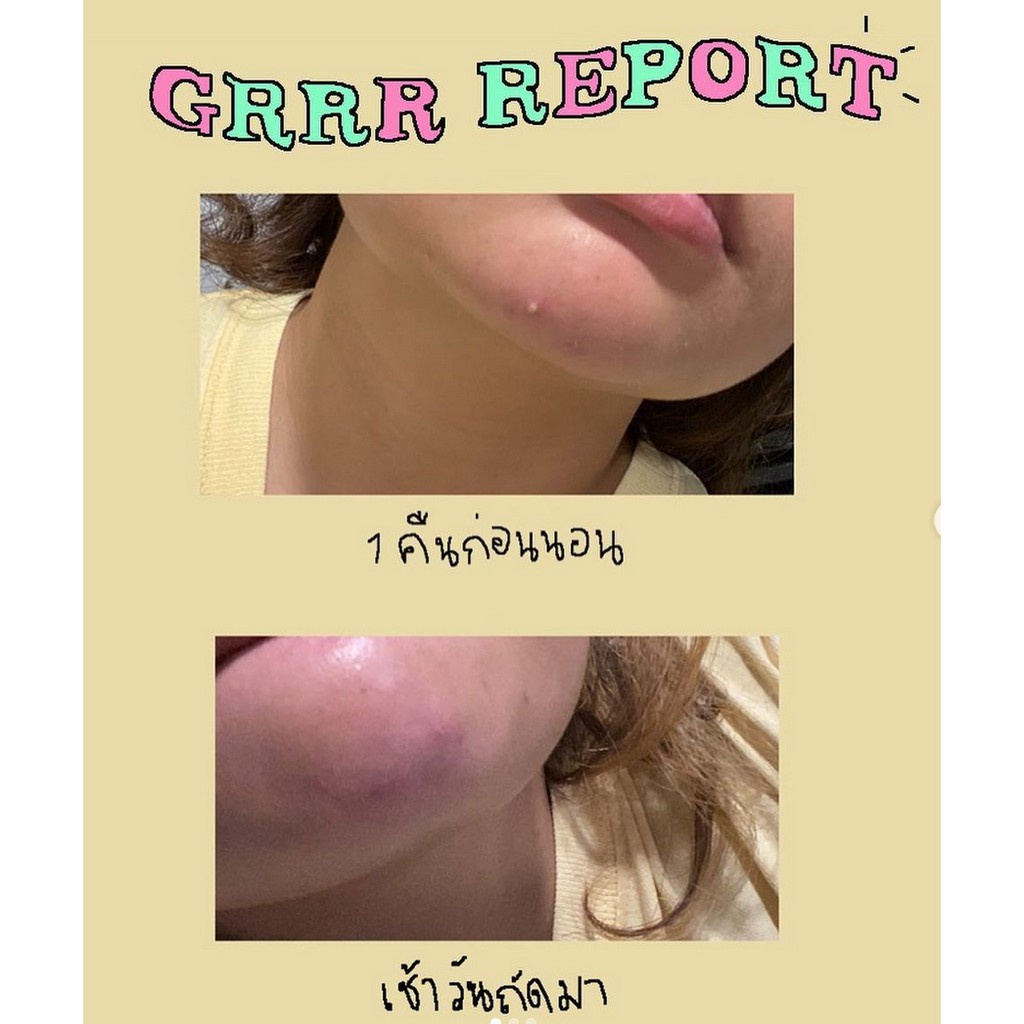 บ้าน✇✾✆แผ่นแปะสิวไฮโดรคอลลอยด์ grrrbeauty ลายหัวใจ heart breaker