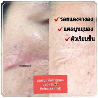 ครีมรักษาแผลเป็น สูตรเข้มข้น clear skin lab