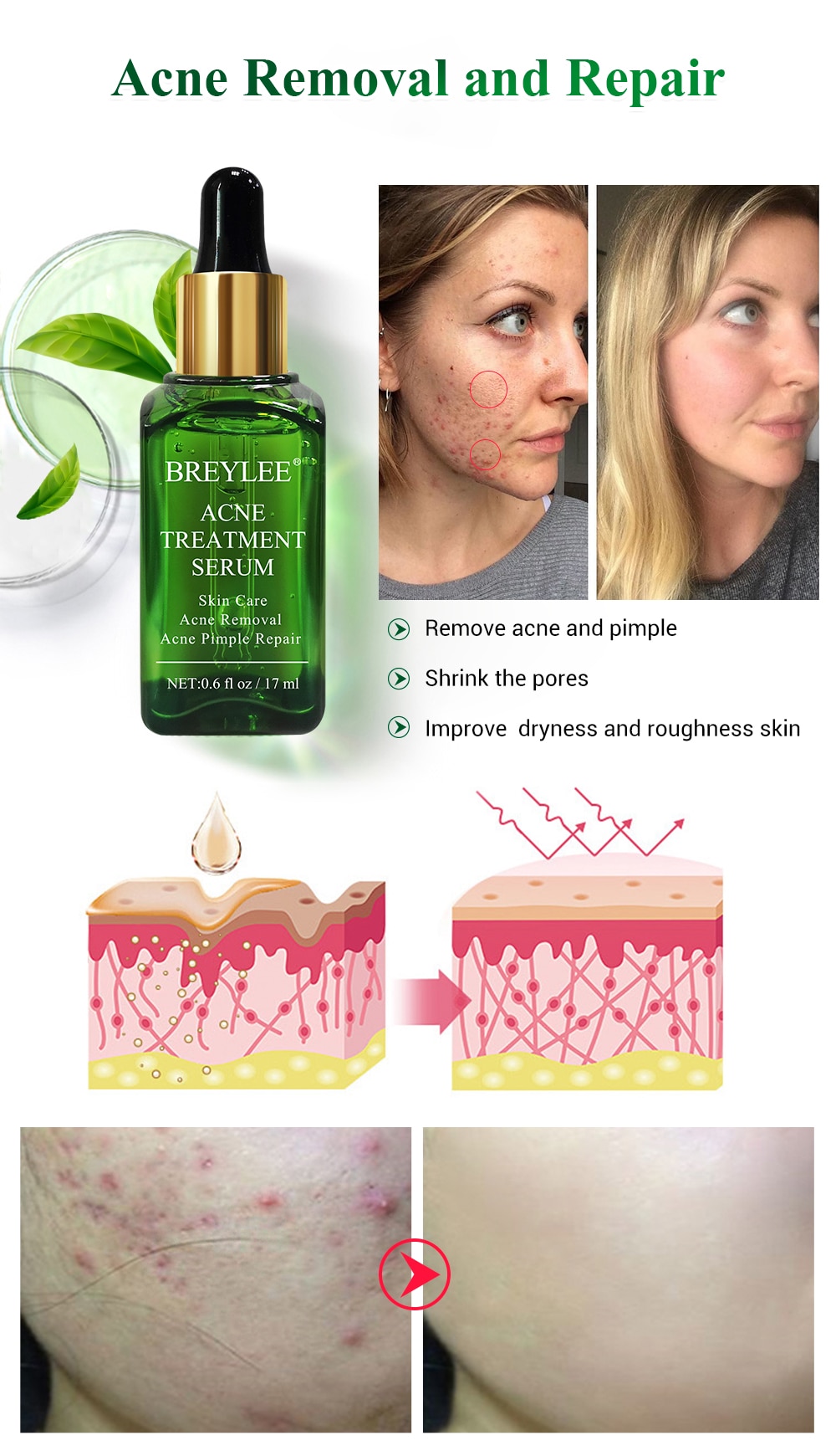 breylee acne treatment kit