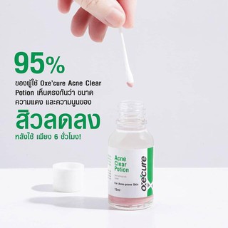 💥หมดอายุ11/22 สิวยุบไวใน 6 ชั่วโมง** โลชั่นแต้มสิว OxeCure Acne Clear Potion 15 มล. ลดสิวอักเสบ สิวอุดตัน สิวผด💥