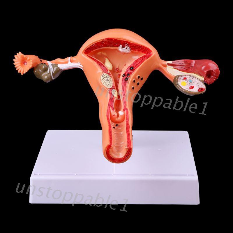 Pathological Uterus Ovary Anatomical Model Anatomy Cross Section Study Tool JZAH