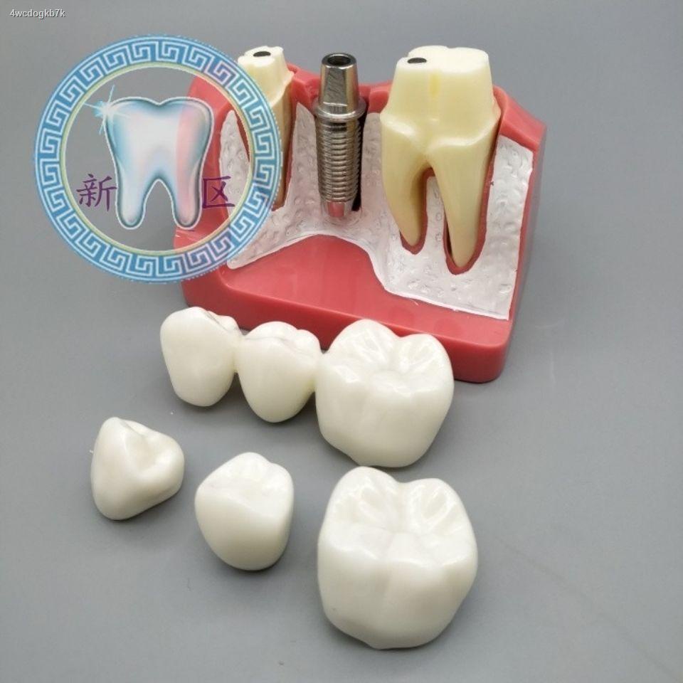 ทันตกรรม❇♂แบบจำลองการตีความรากฟันเทียมสี่เท่า สกรูรากเทียมแบบถอดได้ การซ่อมแซมฟันปลอมและครอบฟันพอร์ซเลน