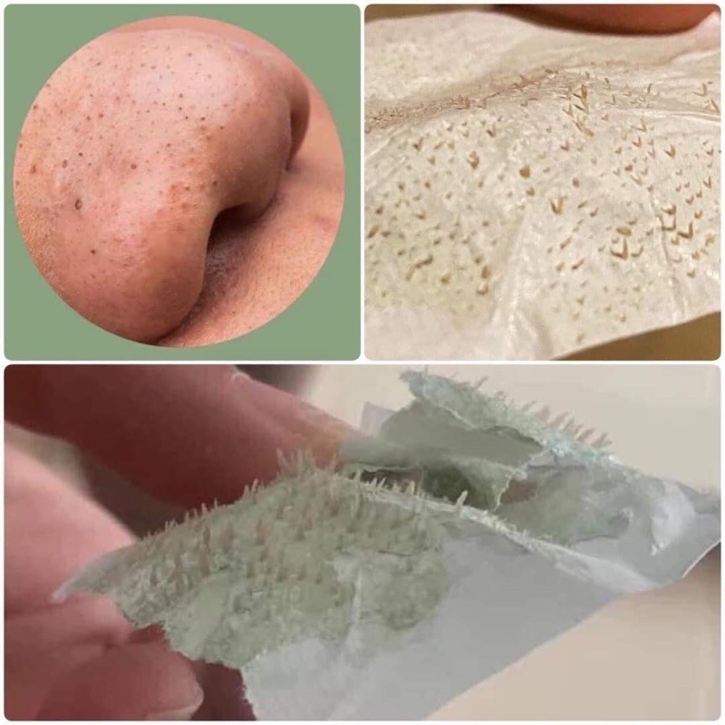 lively noseครีมลอกสิว