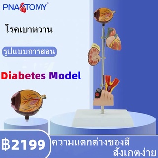 Diabetes Pathology Model ลูกตารุ่นพยาธิสภาพเบาหวาน, ไตหัวใจ, หลอดเลือดแดง, เบาหวาน sclerotic, เท้าที่เป็นโรค, ภาวะแทรกซ้