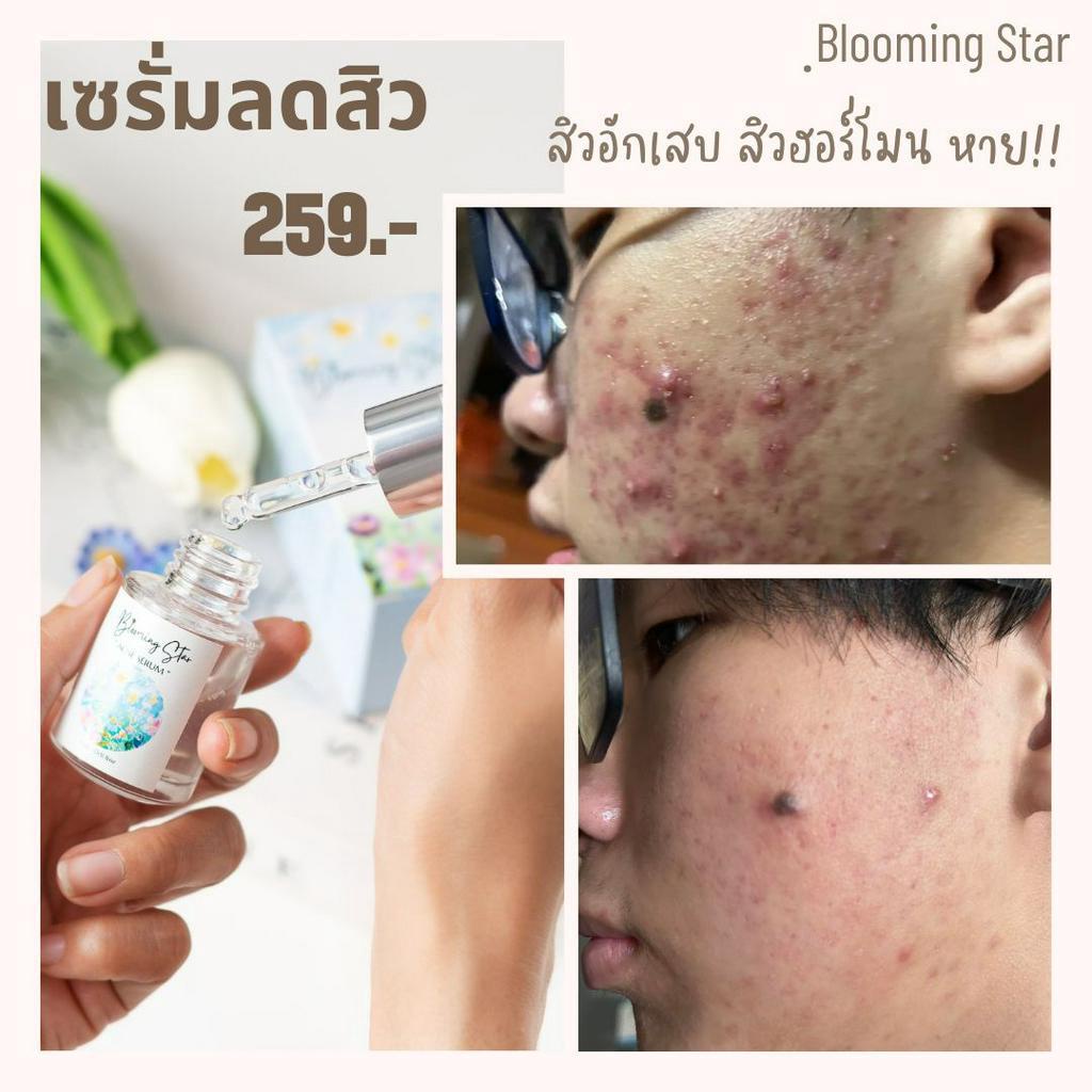 Acne Serum สิวหาย ไร้สิว  เซรั่มสิว   ลดการอักเสบของสิว ฆ่าเชื้อแบคทีเรีย ลดความมัน 15ml