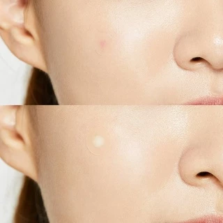 COSRX Acne Pimple Master Patch แผ่นแปะสิว แปะปุ๊ป ยุบปั๊บ! สิวหายหน้าใสแบบเร่งด่วน ช่วยดูดซับสิวหนอง สิวอักเสบ