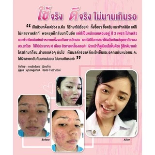 ดร.สาโรช เฮอร์เบิล แอคเน่เคลียร์ โลชั่น (โลชั่นสิว) สำหรับสิวอุดตัน สิวอักเสบ ส่งฟรี