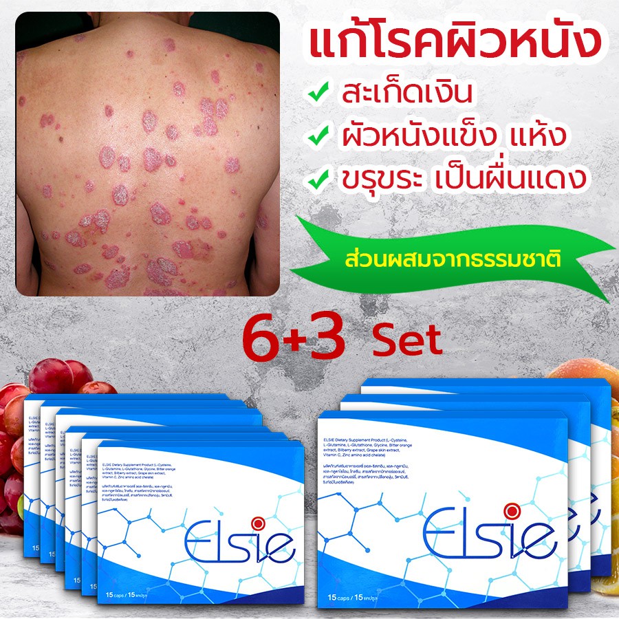 🔥 ELSIE ผลิตภัณฑ์บำบัดรักษาโรคสะเก็ดเงิน กำจัดเชื้อโรค ขับล้างสารพิษ ทำลายแบคทีเรีย ขจัดเซลล์ผิวตาย ☘️ ซื้อ 6 แถม 3