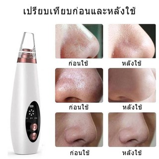 🔥ราคาท้าลมร้อน จัดโปรลดสุดๆ🔥เครื่องดุดสิวเสี้ยนครบชุด 1274