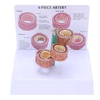 Atherosclerosis โมเดลหัวใจสาธิตโรคกล้ามเนื้ออักเสบ