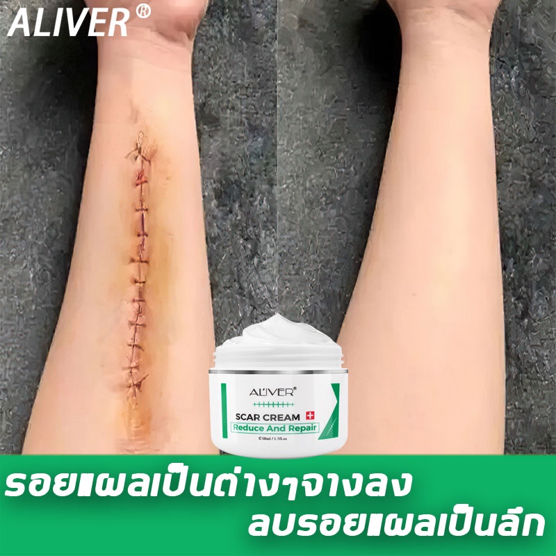 ของแท้ ALIVER 50ml ครีมกำจัดรอยแผลเป็น เจลลดรอยแผลเป็น ครีมกำจัดรอยแผลเป็น แผลเป็น แผลเป็นจากการผ่าตัด