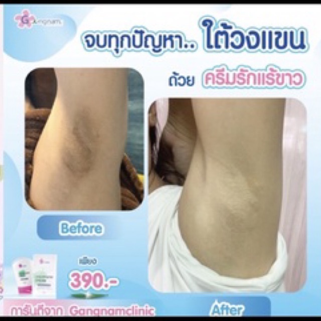 ครีมรักแร้ขาว underarm cream Gangnam clinic 290รวมส่ง
