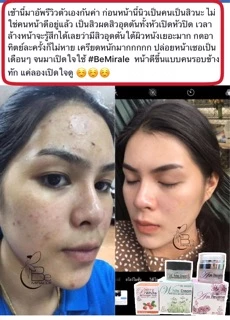 White Cream anti-acne ( บีมิราเคิลครีม) ครีมหน้าใส ครีมลดสิว•ขนาดทดลอง5กรัม•