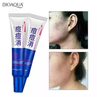 Bioaqua Acne creamครีมรักษาสิว เจลรักษาสิว  ลบสิว ครีมรักษารอยสิว-7626