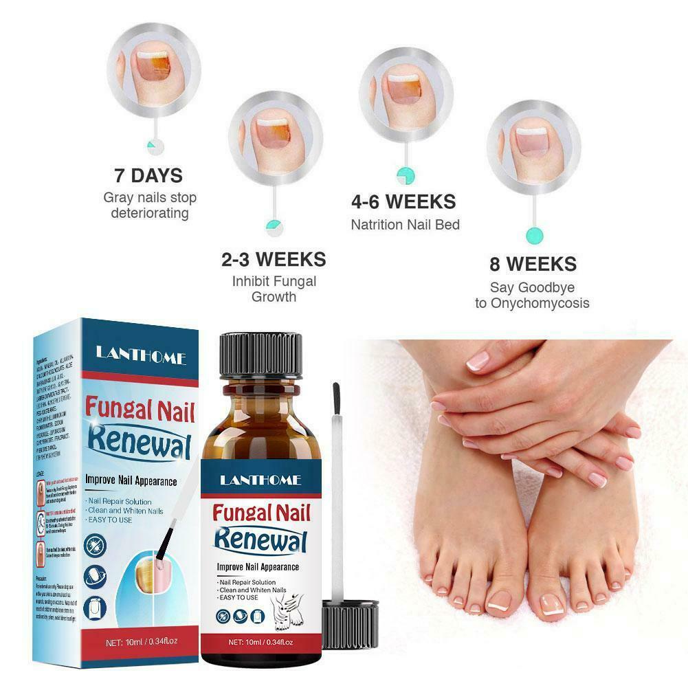 LANTHOME 10ml fungal nail repair nourish fungal nail to anti-infection hand treatment foot G9O6