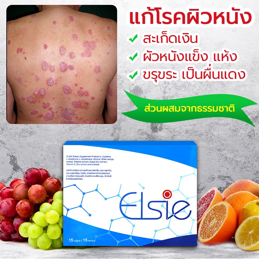 🔥 ELSIE ผลิตภัณฑ์บำบัดรักษาโรคสะเก็ดเงิน กำจัดเชื้อโรค ขับล้างสารพิษ ต้านไวรัส ทำลายแบคทีเรีย ขจัดเซลล์ผิวตาย ☘️ 3 กล่อง