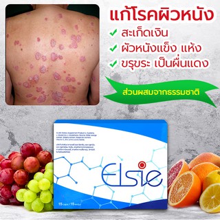 🔥 ELSIE ผลิตภัณฑ์บำบัดรักษาโรคสะเก็ดเงิน กำจัดเชื้อโรค ขับล้างสารพิษ ต้านไวรัส ทำลายแบคทีเรีย ขจัดเซลล์ผิวตาย ☘️ 1 กล่อง