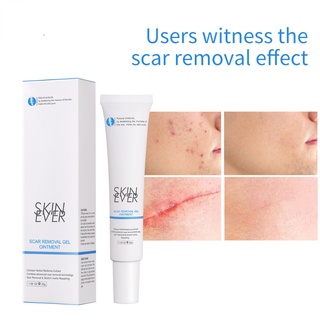Skin EVER ครีมเจลกําจัดรอยแผลเป็นจากสมุนไพร -SK013