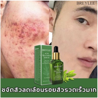 ของแท้ BREYLEE เซรั่มลดสิว ครีมลดสิว ครีมแต้มสิว เจลแต้มสิว เจลรักษาสิว ครีมกำจัดสิว ครีมรักษาสิว ครีมสลายสิว กำจัดสีว