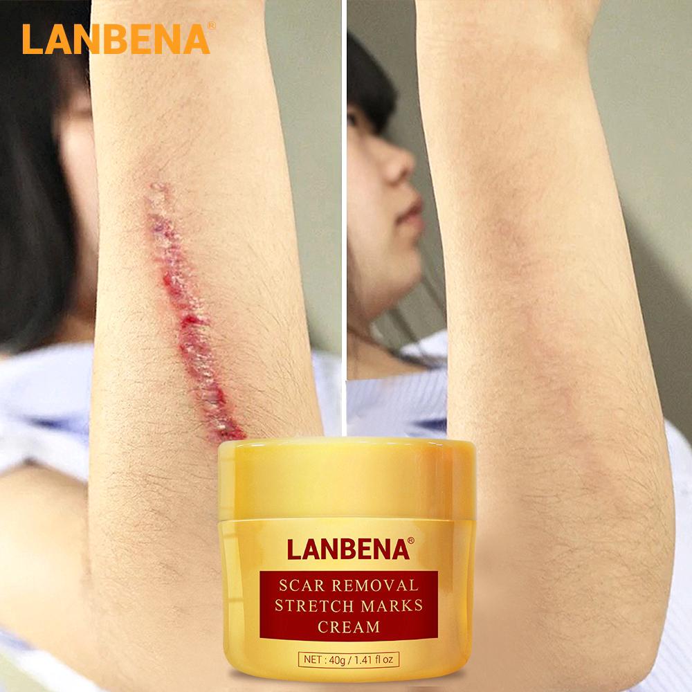 LANBENA ครีมรักษารอยแผลเป็น