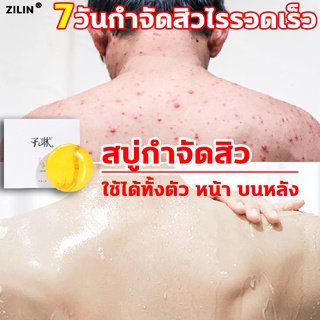 ZILIN สบู่ลดสิวหน้า สบู่กำจัดไร สบู่กำจัดสิว สบู่ป้องกันแบคทีเรีย สบู่รักษาสิว สบู่ควบคุมความมัน สบู่ลดสิว สบู่ลดสิวหลัง