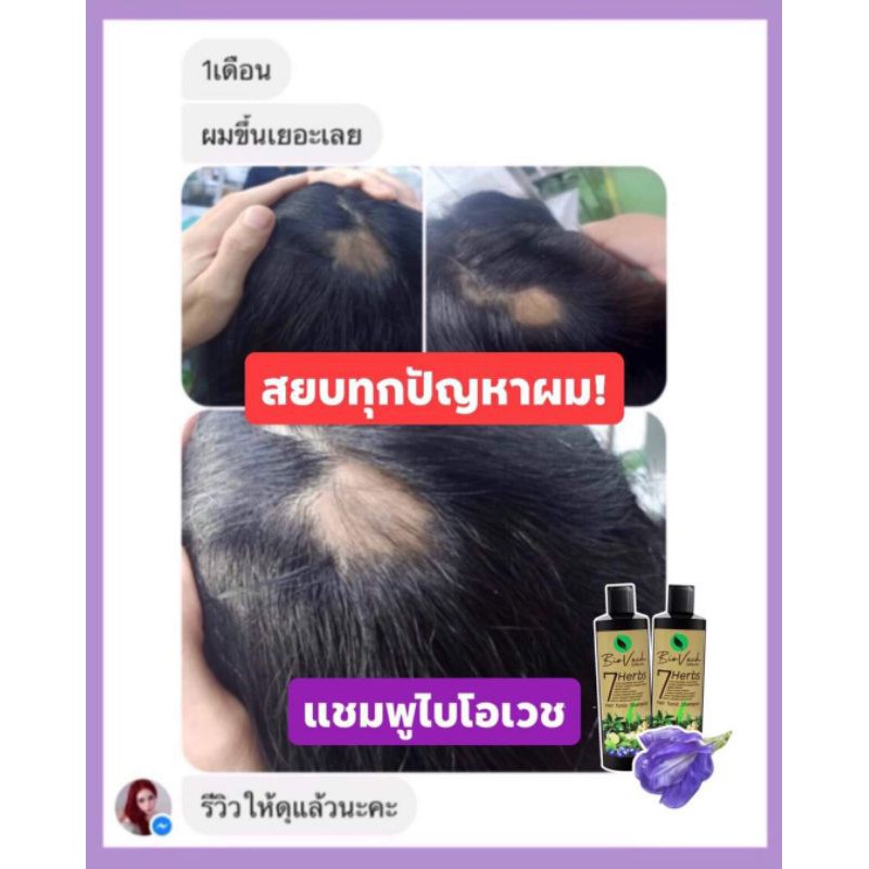 ไบโอเวชของแท้100แชมพูปลูกผมดก เร่งผมยาว แก้ศรีษะล้าน กระตุ้นการเกิดผมใหม่ สูตรสมุนไพรเข้มข้นฟรี