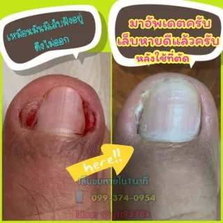 ตัดเล็บขบ​ แยกชิ้น หลายขนาด ตัดง่ายไม่เจ็บของแท้