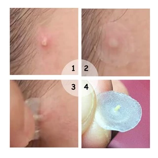 Breylee แผ่นแปะสิว ช่วยลดอาการอักเสบของสิว รักษาสิว แผ่นแปะสิวกลางคืน