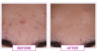 สั่งล่วงหน้า: Neutrogena Light therapy acne spot treatment #6