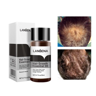 Lanbena Natural Fast Powerful Hair Growth Essence น้ํามันหอมระเหย ป้องกันผมร่วง 20 มล.