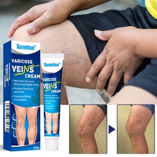 【สินค้าพร้อม】Sumifun Varicose Veins Remover มีประสิทธิภาพ Original Varicose Veins Remover สำหรับขา