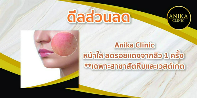 [ดีลส่วนลด] Anika Clinic : laser หน้าใส ลดรอยแดงจากสิว 1 ครั้ง