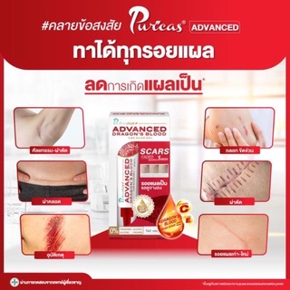 สินค้าขายดี❤️❤️Dragon Blood Advanced gel สูตรเข้มข้นรักษาแผลเป็นเร่งด่วนใน 1 สัปดาห์ ขนาด 9 กรัม (1 หลอด)