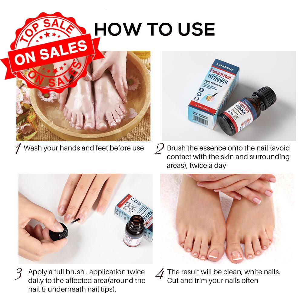 LANTHOME 10ml fungal nail repair nourish fungal nail to anti-infection hand treatment foot G9O6