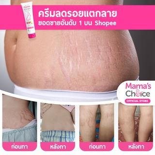 Mama'S Choice เซ็ทครีมลดรอยแตกลาย (X3) ครีมทาท้องลาย ลดรอยแตกลาย ท้องลาย  ขาแตกลาย ปลอดสารเคมี - Stretch Mark Cream Set | Shopee Thailand
