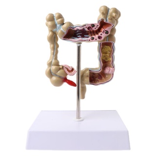 Stat Human Colorectal Lesion Model Pathological Anatomy Colon Diseases Intestine Medical Teaching Learning Tool KTHY