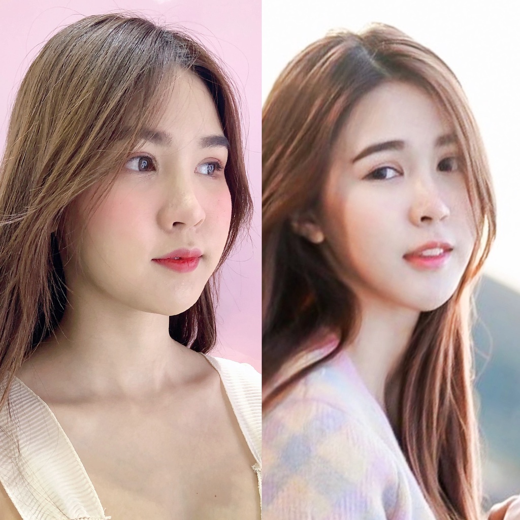 Botox (Nabota) Wrinkles or Jawline or Face Lift / ริ้วรอย หรือ กราม หรือ ลิฟหน้า โบท็อกเกาหลียี้ห้อเดียวที่ได้ US FDA