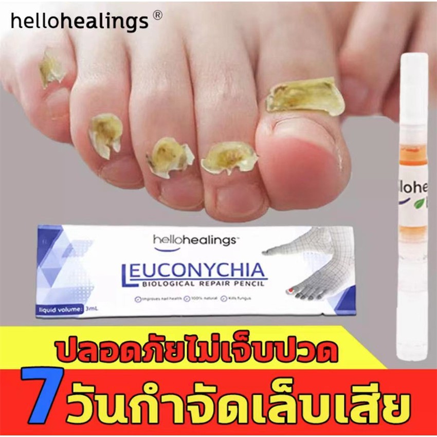 ▩ เซรั่มรักษาเล็บ รักษาเล็บ Hellohealings เล็บเท้าคุณภาพสูงกำจัดเชื้อราที่เล็บ เอ็สเซ้นซ่อมแซมเล็บเสีย รักษารคเชื้อราที�