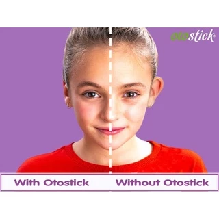 🔥แก้หูกาง🔥 OTOSTICK 2 แพ็ค แบบเนียนเป็นธรรมชาติสุด ยกกล่อง ล็อตใหม่ล่าสุด ฟรีแผ่นแอลกอฮอล์