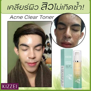 ลดสิว ผิวมัน ไม่มีน้ำหอม KIZZEI Men Acne Toner มี BHA โทนเนอร์ลดสิวอุดตัน หน้ามันเป็นสิว ลดสิวอุดตัน สิวผู้ชาย ของแท้