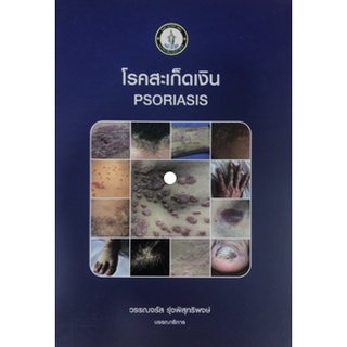 โรคสะเก็ดเงิน (PSORIASIS) 9786167741505