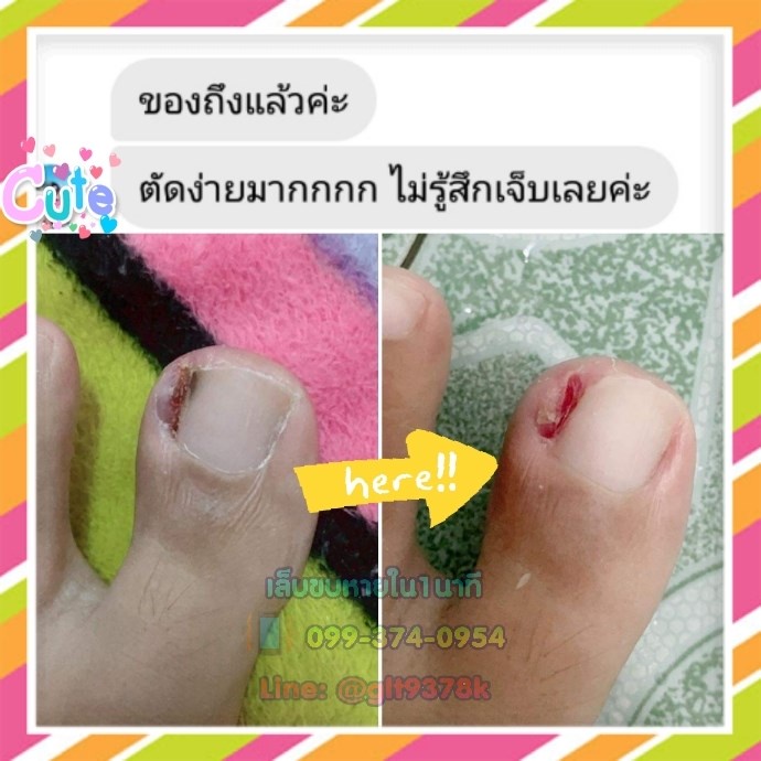 แซะซอกเล็บ ตัดเล็บขบ แบบเปลี่ยนใบมีด เลาะเล็บขบสำหรับมืออาชีพ - รูปที่ 3