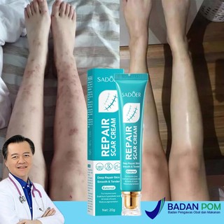 Salep penghilang bekas luka Penghilang bekas luka hitam koreng Penghilang bekas gigitan nyamuk 20g bekas luka di kaki keloid bekas luka bakas dan stretch mark Bekas Luka Luka Jahitan Bekas hitam koreng obat penghilang bekas luka Salep