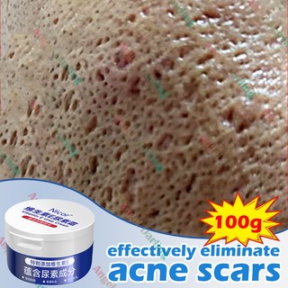 Salep jerawat Salep jerawat dan bekas jerawat Obat jerawat paling ampuh 100g Vitamin E Manghilangkan Jerawat Dan Bintik, Menghaluskan Dan Memutihkan Kuli,Obat jerawat dan bekas jerawat paling ampuh,Penghilang jerawat dan bekas jerawat