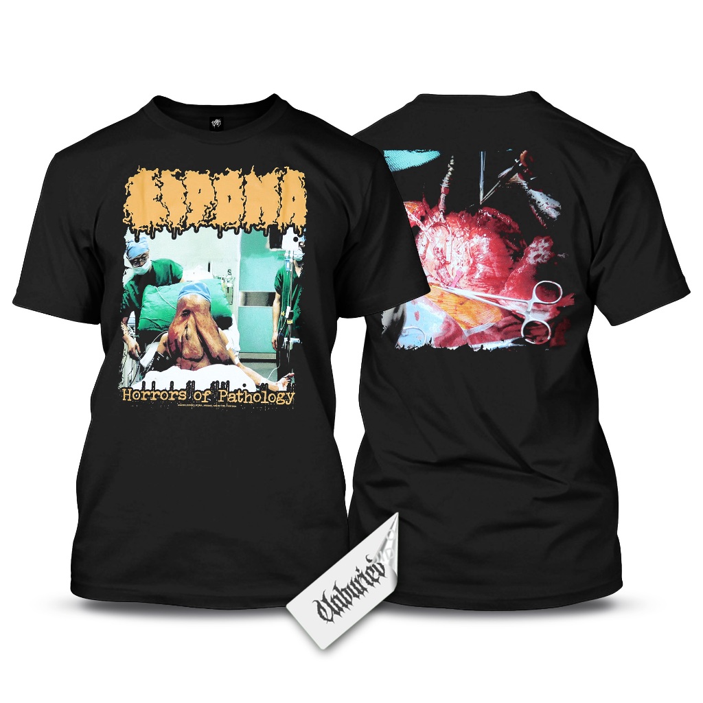 Short Sleeve - Lipoma - Horrors of Pathology